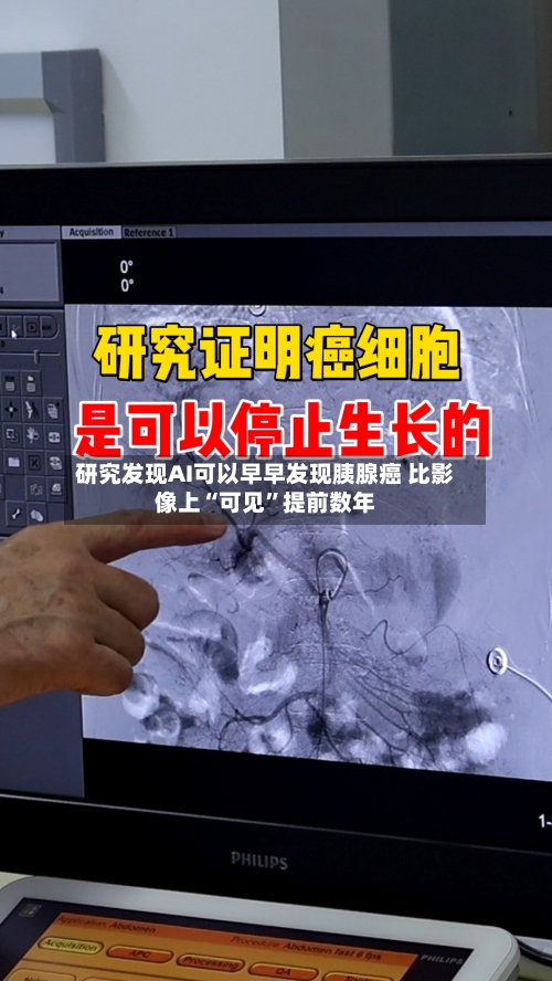 研究发现AI可以早早发现胰腺癌 比影像上“可见”提前数年-第2张图片
