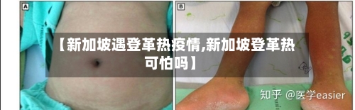 【新加坡遇登革热疫情,新加坡登革热可怕吗】